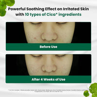 Red Blemish Clear Soothing Cream